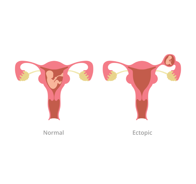 ectopic