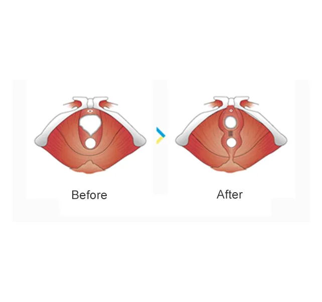 hymenoplasty