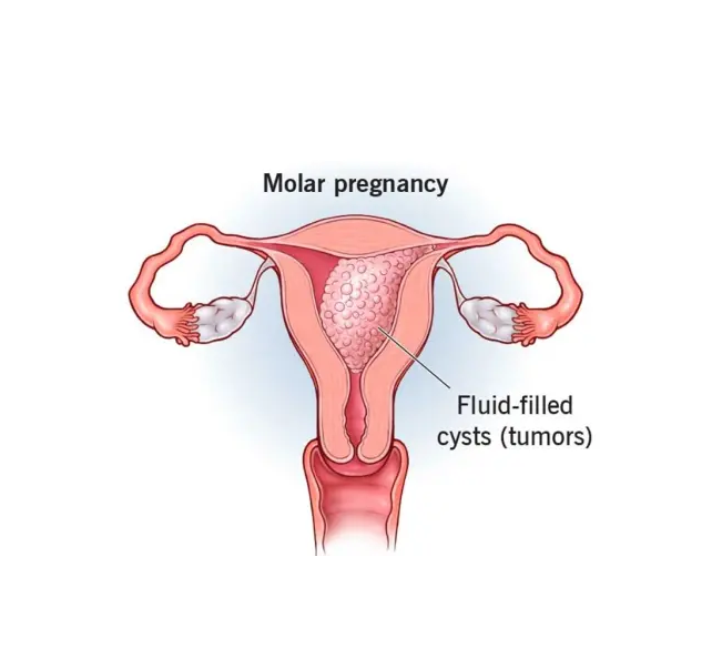 molar pregnancy