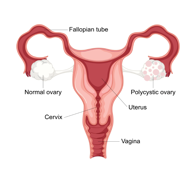 pcod pcos