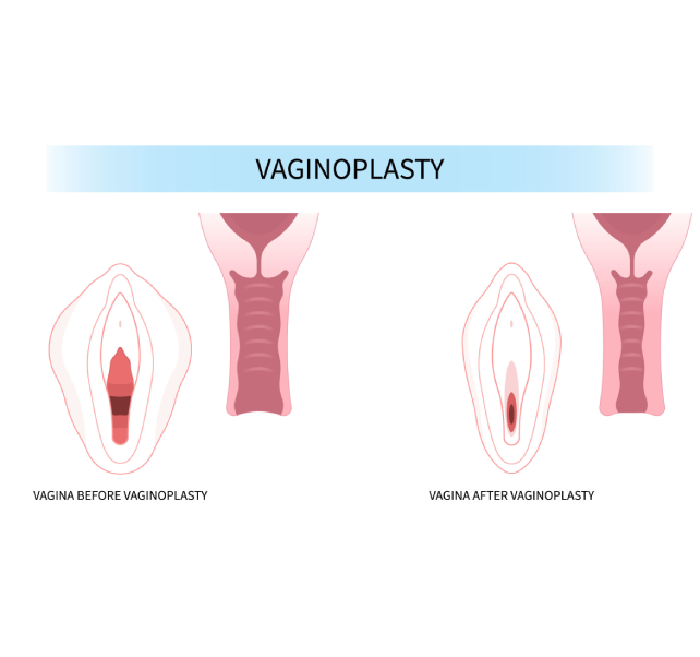 vaginoplasty