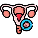 ovarian cyst