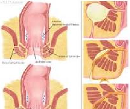 fistula