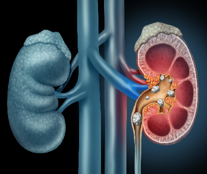 Kidney Stone